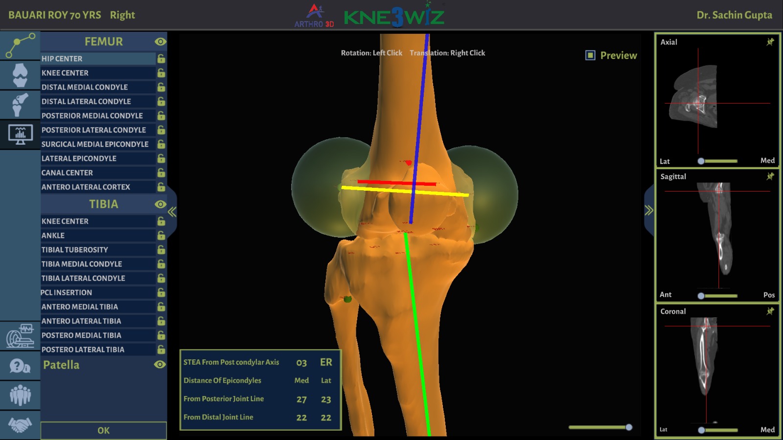 ARTHRO3D Kne3Wiz software showing 3D knee model with surgical landmarks.