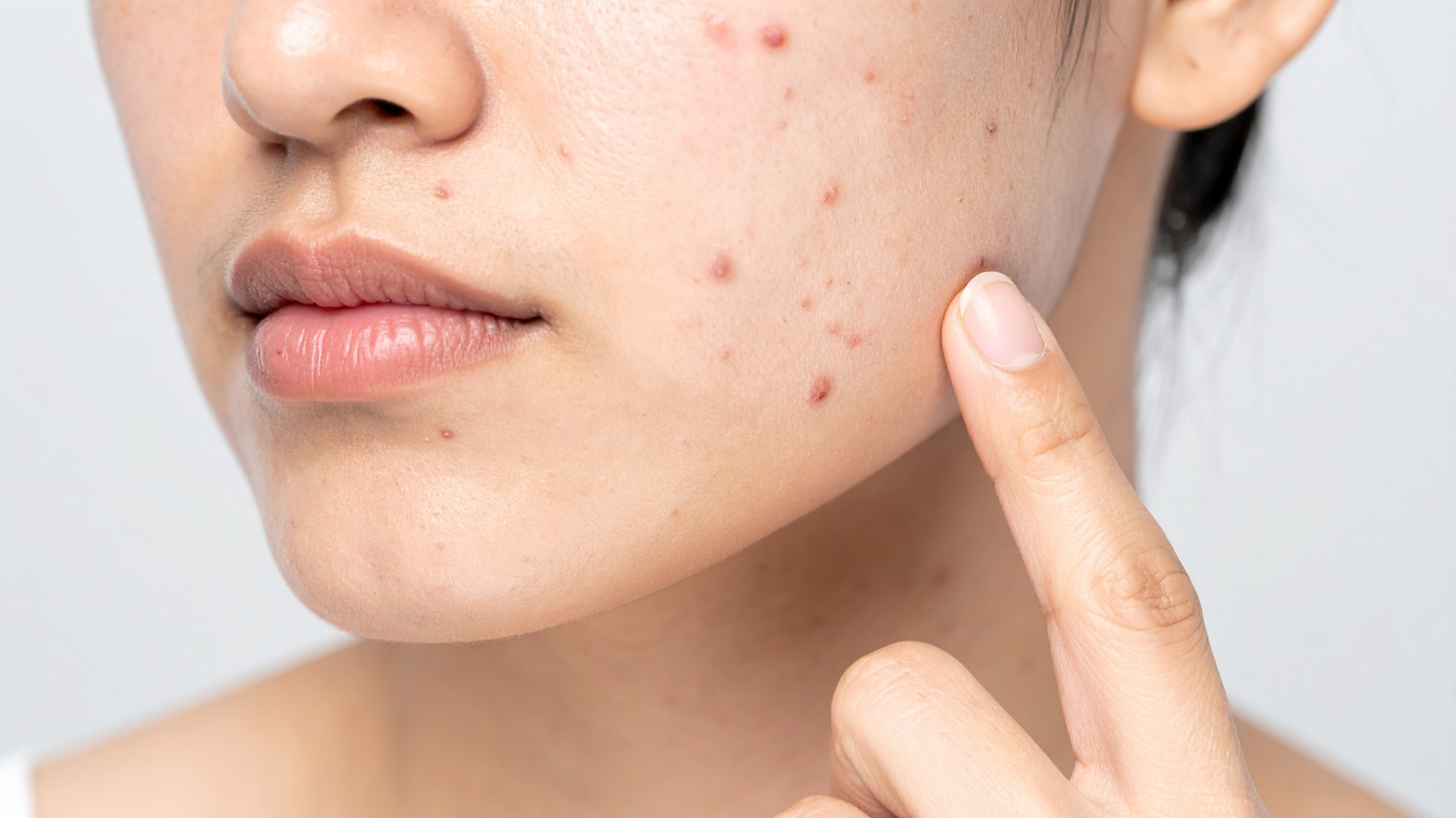 Close-up of facial skin during dermatology consultation.